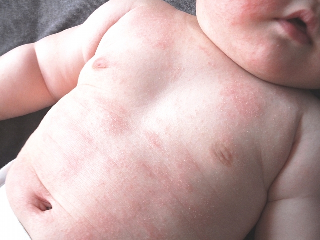 乳児湿疹は全身に広がる 悪化してしまう原因と間違えやすい肌トラブルも 双子ままの日々のコト