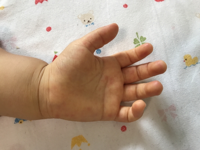 子供の手足口病の発疹のかゆみはいつまで続く 対処法は 市販のかゆみ止めでおすすめは 双子ままの日々のコト