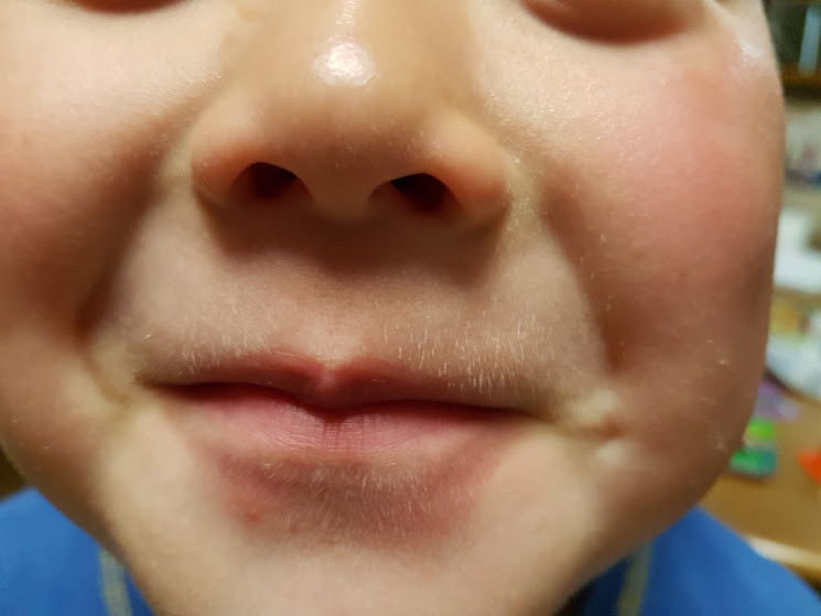 唇の荒れの原因や対策で子供は おすすめケア方法はコレ 双子ままの日々のコト