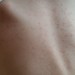 突発性発疹の症状と写真　2回なる？保育園や幼稚園はいつまで？