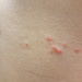 水いぼの受診は何科？子供の治療法でピンセットはどうなの？期間は？